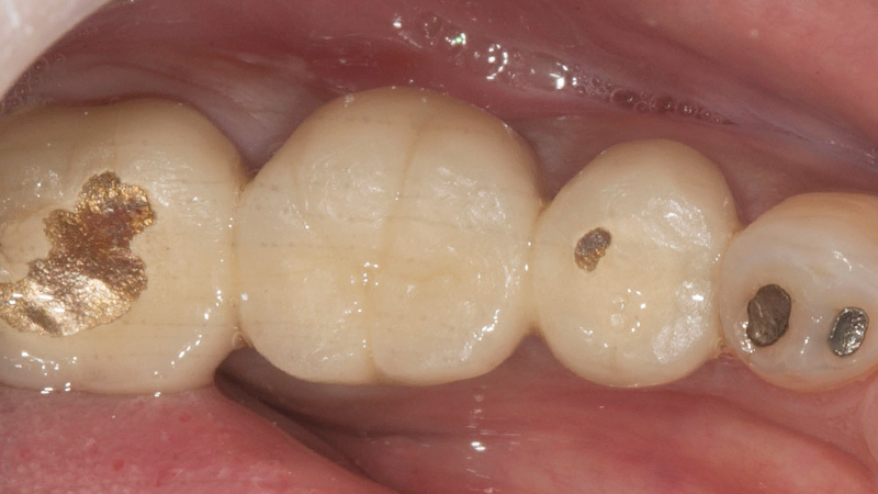 Patient before photo with worn out existing PFMs