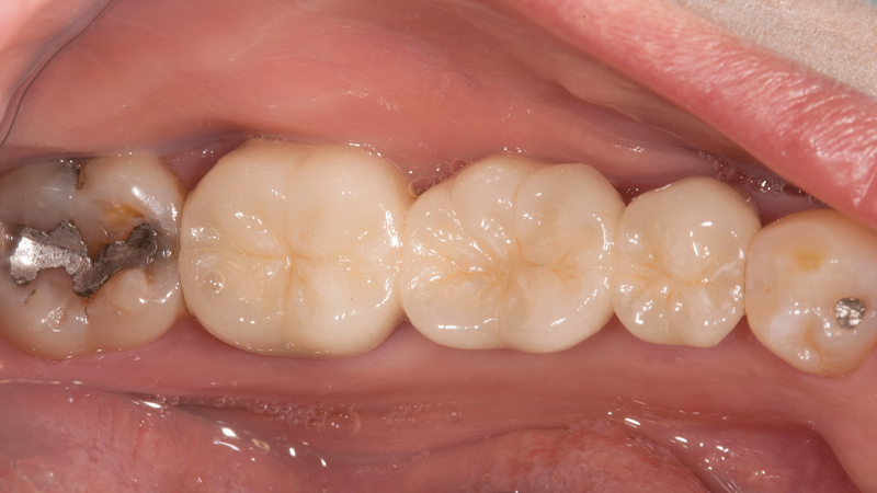 After photo of female patient's restoration removal and Obsidian Fused to Metal bridge seated