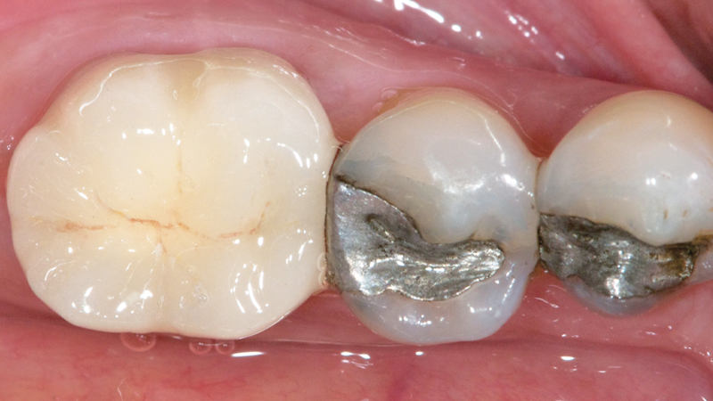 after photo of patient with new restoration, Obsidian Fused to Metal was used