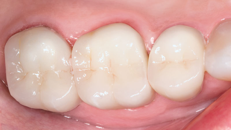 Clinical Study: Bilayered Clinical Zirconia crowns were placed on teeth #2–4 