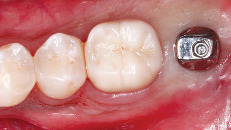 A Hahn Tapered Implant was seated through the guide
