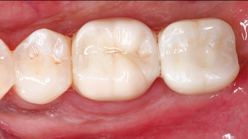 After the healing phase, a custom abutment and a BruxZir® Solid Zirconia crown were delivered with ease