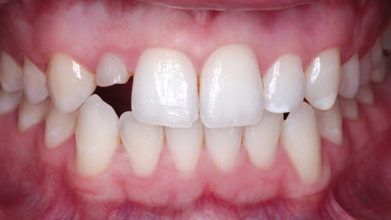 Patient needed long-term solution for a retained primary tooth