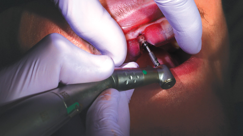 Hahn Guided Surgery System was used to create the implant osteotomy in the exact location determined by the clinician-approved digital treatment plan