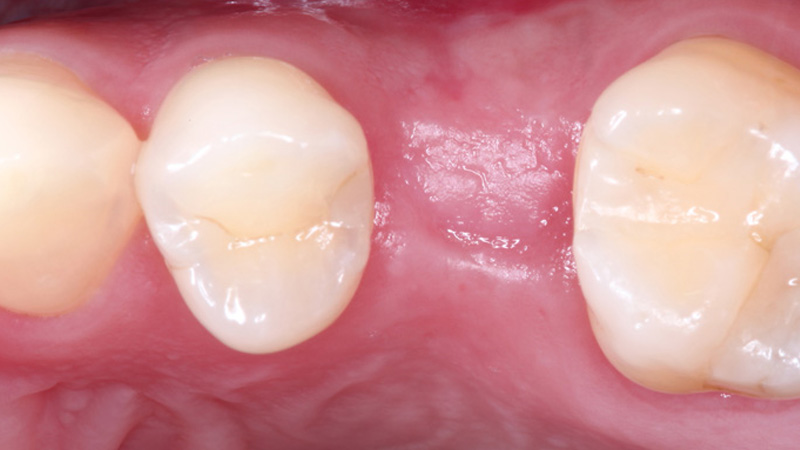 A case-specific surgical guide and plan were used to restore tooth #13 with a 3.5 x 10 mm Hahn Tapered Implant.