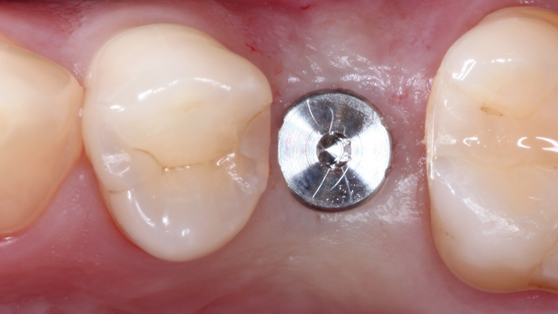 Results of a guided surgical approach