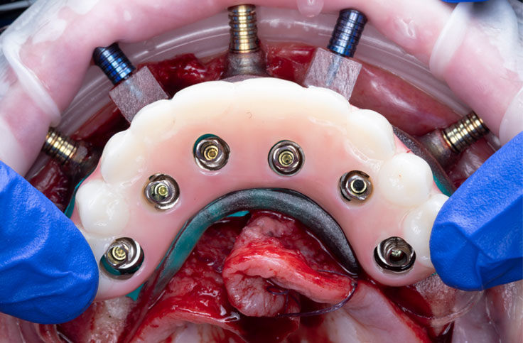 temporary cylinders are added to the implants