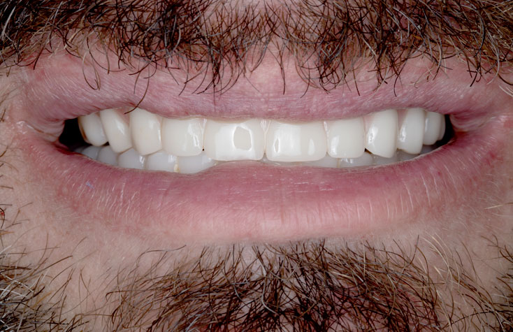 After photo of patient's recovered teeth