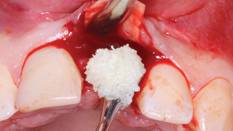 Applying resorbable collagen membrane and minteralized cortico/cancellous allograft blend as regenerative solution
