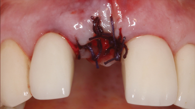 Area of tooth extraction is sutured