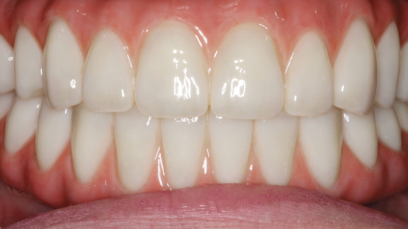 After image of patient with BruxZir Esthetic Prosthesis