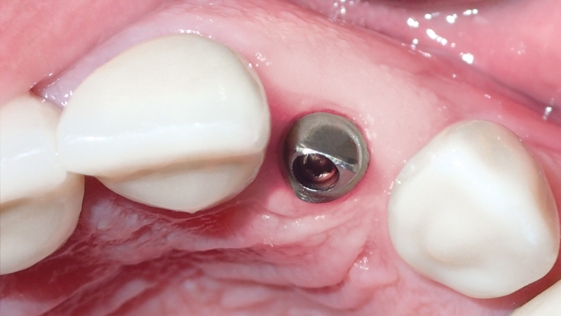 Four months after implant placement, a titanium custom abutment was delivered with ease