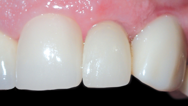 Final Obsidian® All-Ceramic restoration blended well with the surrounding teeth