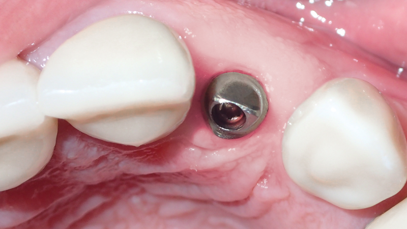 before photo of implant placement