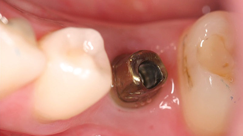 image before of a gold-tone titanium custom abutment was delivered at a healed implant site