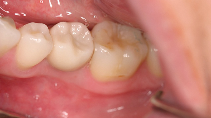 image after final BruxZir Full-Strength crown was cemented over the custom abutment