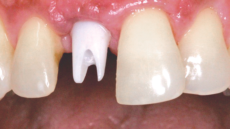 before photo of implant placed to restore upper central incisor