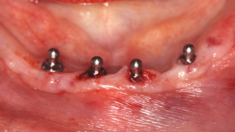 Small-diameter implants were placed to support a mini implant overdenture