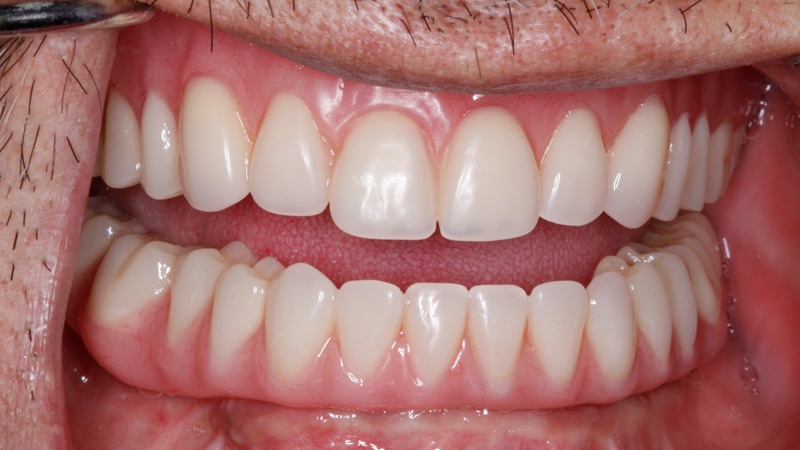 AFTER: After placing implants and allowing several months for integration and healing, the patient was restored with screw-retained hybrid dentures