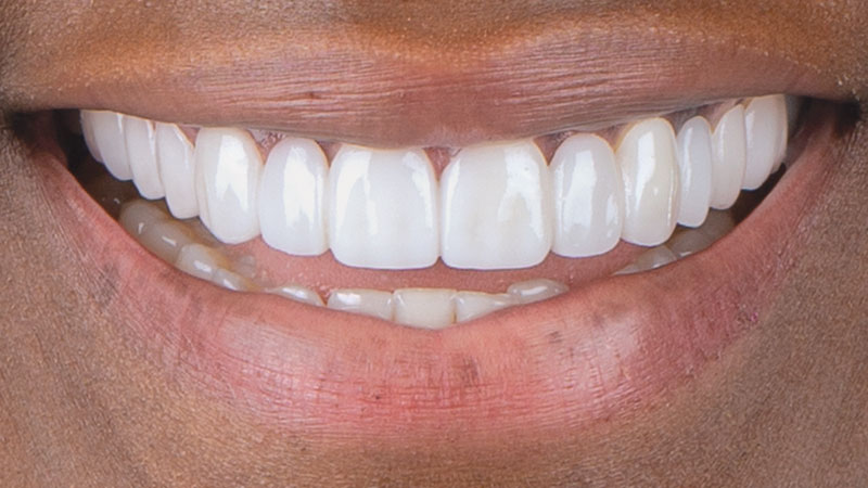 Smile Transitions appliance was prescribed to help give the patient a preview of how her permanent smile could look after completing orthodontic and veneer treatments
