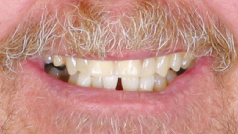 Milled Acetal Partial Dentures After