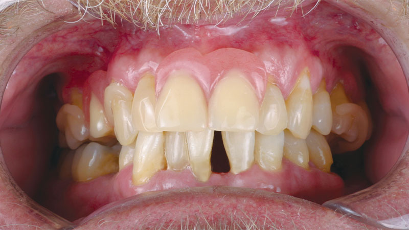 Milled Acetal Partial Dentures Before